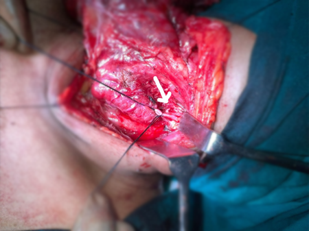 Thyroid Surgeon in India